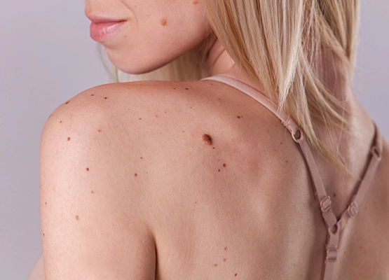 Affordable skin tag removal services in Ottawa