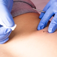 Sun damage skin treatment in Ottawa