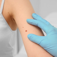 Ottawa dermatologist for pigmentation problems in youth