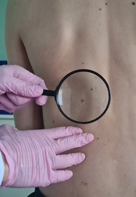 Cosmetic mole and skin tag removal clinic in Ottawa