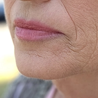 Best lip fillers in Ottawa for natural results