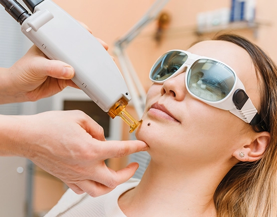 Affordable cosmetic mole removal procedures in Ottawa