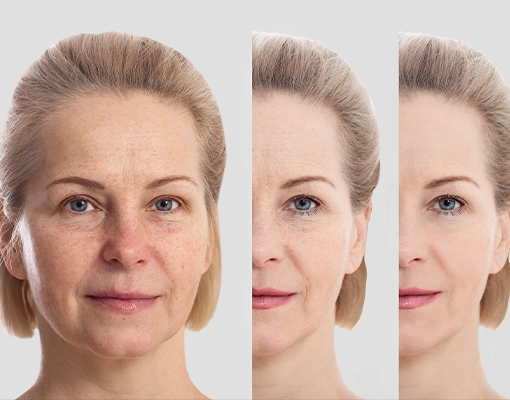 Neuromodulator treatments explained for Ottawa residents